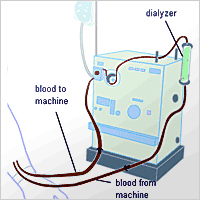 Máquina de diálisis